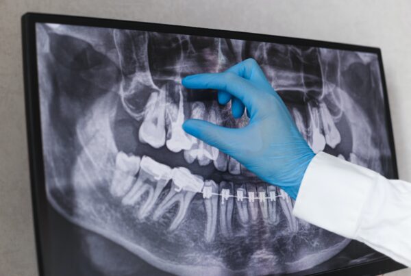 Doctor points to filled root canal in dental x-ray